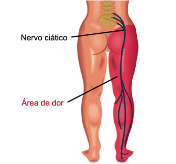 Imagem: https://www.drsabag.com.br/lombar/dor-ciatica-sintomas-causas-e-tratamentos/